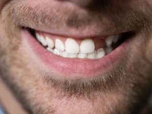 Dlaczego nie warto zwlekać z uzupełnieniem braków zębowych? - Amadent Blog